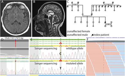 Case Report: Association of a Variant of Unknown Significance in the FIG4 Gene With Frontotemporal Dementia and Slowly Progressing Motoneuron Disease: A Case Report Depicting Common Challenges in Clinical and Genetic Diagnostics of Rare Neuropsychiatric and Neurologic Disorders